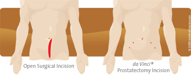 da Vinci® Prostatectomy Incision Diagram